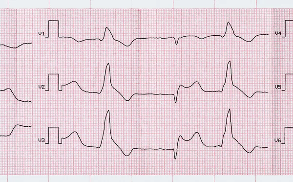 Tape ECG with macrofocal myocardial infarction and ventricular premature beats — Stock Photo, Image