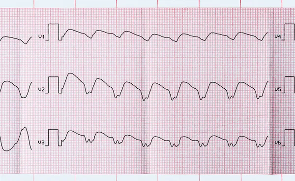 Tape-EKG med paroksysmal ventrikulær takykardi – stockfoto