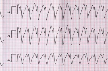 EKG Atriyal flutter paroxysm doğru formu ile