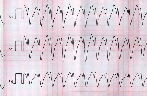 EKG med paroxysm rätta formen av förmaksfladder — Stockfoto