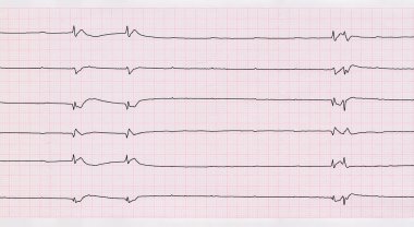 EKG tek ventrikül kompleksleri ve ventrikül kalp kası yetmezliği ile 