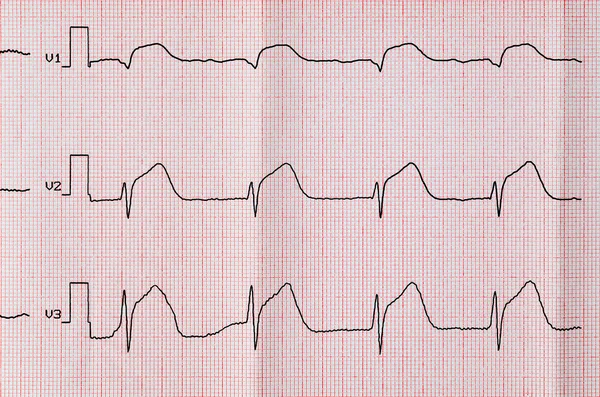 EKG ile akut dönem macrofocal ön yüz Miyokard İnfarktüsünde