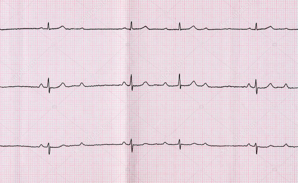 Atrioventricular Block Ecg