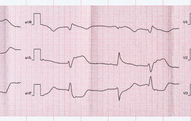 Akut dönem macrofocal Miyokard İnfarktüsü ve Ventriküler Prematüre yener ile EKG