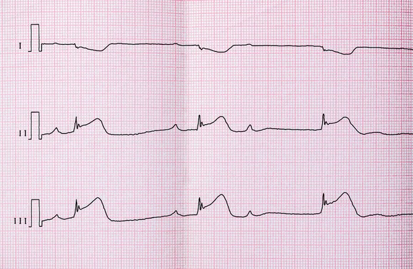 ECG ที่มีระยะเวลาเฉียบพลันของกล้ามเนื้อหัวใจตายขนาดใหญ่ AV block II ประเภท Mobitts I — ภาพถ่ายสต็อก