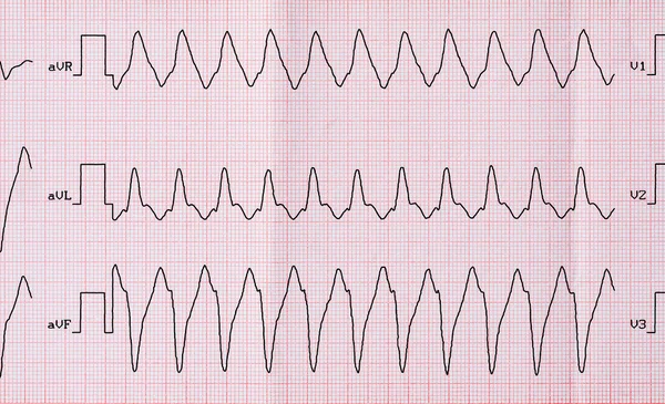 EKG s záchvatu správný tvar flutteru síní s atrioventrikulární vedení 1: 1 — Stock fotografie