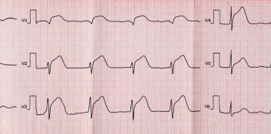 EKG ile akut dönem macrofocal ön yüz Miyokard İnfarktüsünde