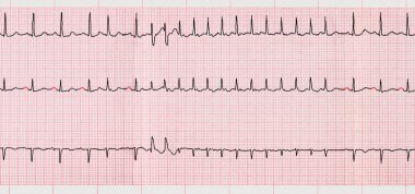 EKG Supraventriküler aritmiler ve Atriyal Fibrilasyonun kısa paroxysm