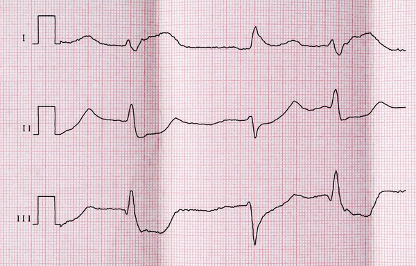 EKG ile akut dönemde Miyokard İnfarktüsü ve Ventriküler Prematüre yener