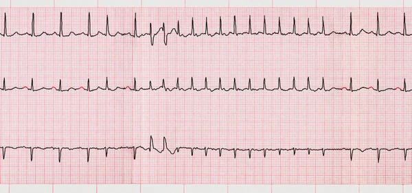 ECG con arritmias supraventriculares y paroxismo corto de fibrilación auricular — Foto de Stock