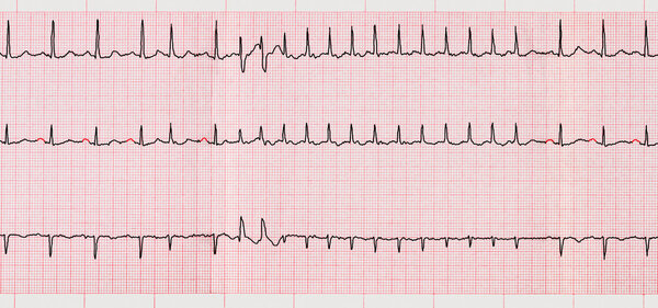 ECG with supraventricular arrhythmias and short paroxysm of atrial fibrillation