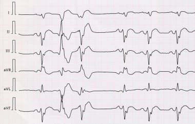 EKG ile macrofocal akut miyokard infarktüsü ve çift ventrikül erken yener