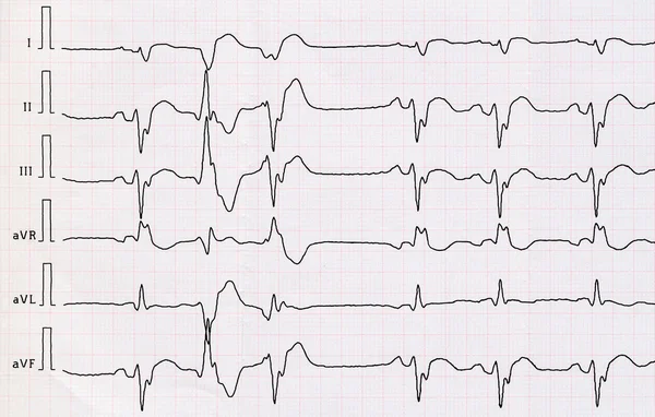 ECG กับกล้ามเนื้อหัวใจตายขนาดใหญ่และจังหวะการเต้นของหัวใจก่อนวัยอันควรคู่ — ภาพถ่ายสต็อก