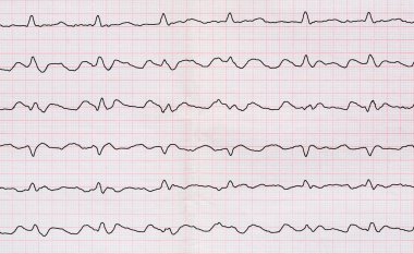 EKG Atriyal flutter Atriyoventriküler iletim 2:1 ile paroxysm doğru formu ile