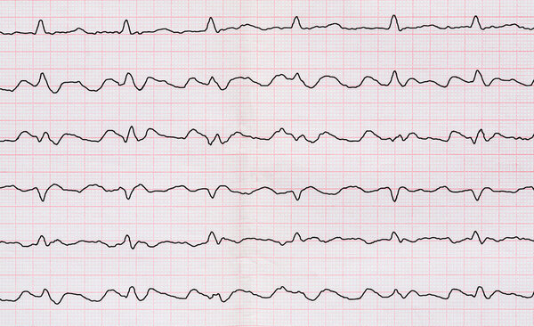 ECG with paroxysm correct form of atrial flutter with atrioventricular conduction 2:1