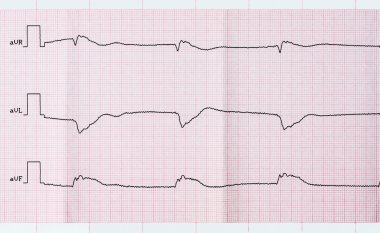 Klinik ölüm ve başarılı bir resüsitasyon sonrası EKG teyp
