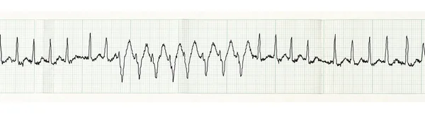 EKG paroxysm Atriyal Fibrilasyonun ve İntraventriküler iletim geçici bozuklukları ile