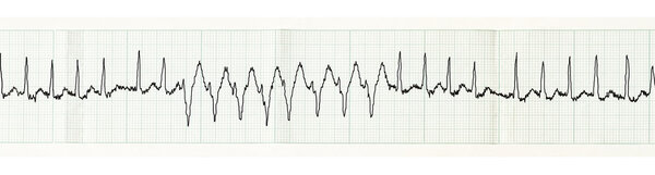ECG with paroxysm of atrial fibrillation and transient disturbances of intraventricular conduction