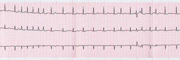EKG Supraventriküler erken beats ve Atriyal Fibrilasyonun kısa paroxysms — Stok fotoğraf
