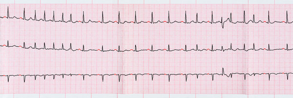 ECG with supraventricular premature beats and short paroxysms of atrial fibrillation