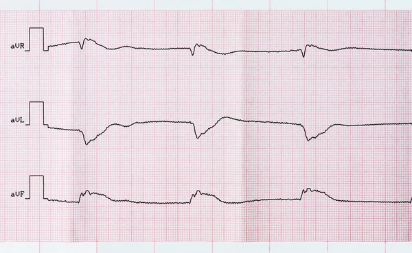 ECG de cinta después de la muerte clínica y una resucitación exitosa — Foto de Stock