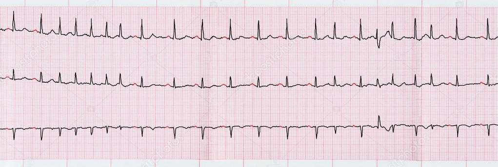 ECG with supraventricular premature beats and short of atrial fibrillation Stock by ©Olga355 76102919