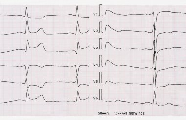 EKG macrofocal posterior miyokard infarktüsü akut süresi ile