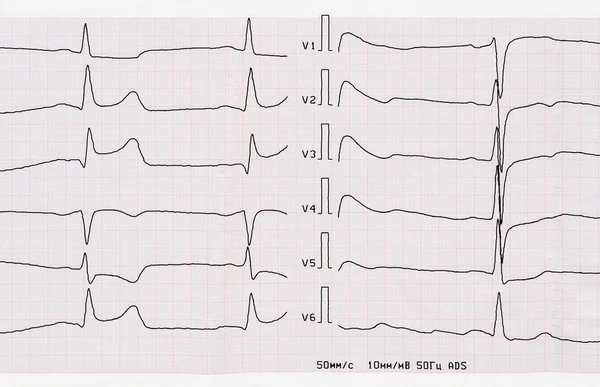 ECG com período agudo de infarto do miocárdio macrofocal posterior — Fotografia de Stock