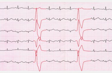EKG ile Ventriküler Prematüre beats (quadrigeminia bant)