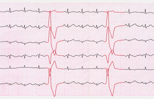 EKG ile Ventriküler Prematüre beats (quadrigeminia bant)