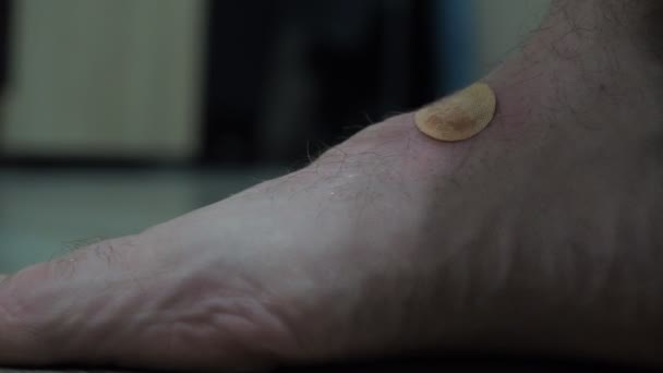 Боль в ноге. Человек снимает пластырь с гнойной раны — стоковое видео