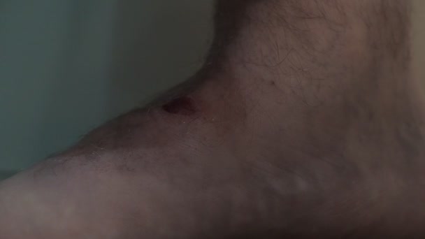 Мужчина надевает пластырь на рану на волосатой ноге — стоковое видео