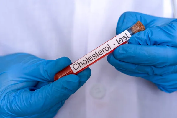 Tangan Sarung Tangan Medis Memegang Botol Darah Untuk Tes Kolesterol — Stok Foto
