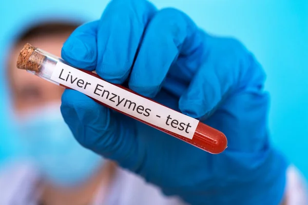 Tıbbi eldivendeki bir el karaciğer enzimlerini test etmek için bir matara tutar. Tıp ve araştırma kavramı.