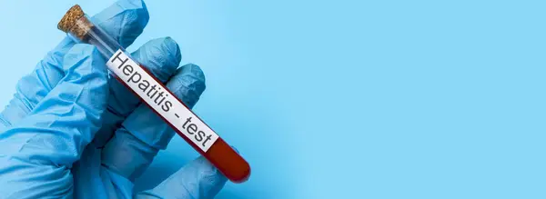 Prueba Hepatitis Sangre Tubo Ensayo Concepto Medicina Análisis Colocar Debajo — Foto de Stock