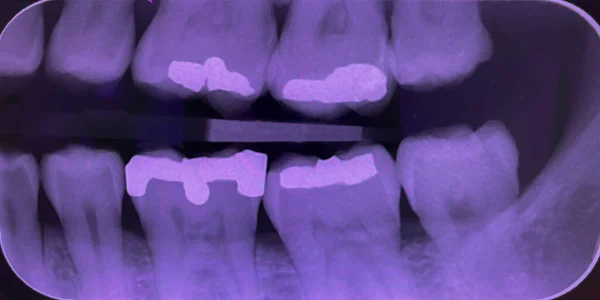 Δαγκωτική Οδοντιατρική Ακτινογραφία Δείχνουν Ρίζες Δοντιών Και Σφραγίσματα Αμαλγάματος — Φωτογραφία Αρχείου