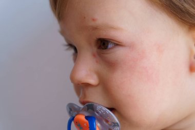 Sağlık, cilt bakımı, pediatri, cilt iltihabı konseptleri. Yanaklarında kurumuş deri döküntüsü olan küçük bir bebeğin yüz görüntüsü. Gıda alerjisi un ürünleri, glüten duyarlılığı...