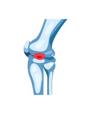 Romatoloji diz kemikleri