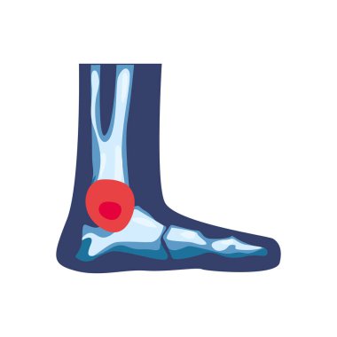 Romatoloji ayak kemikleri