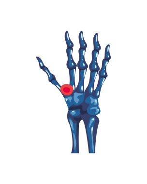 romatoloji el kemikleri