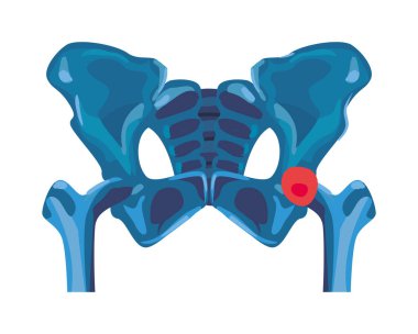 Romatoloji leğen kemikleri