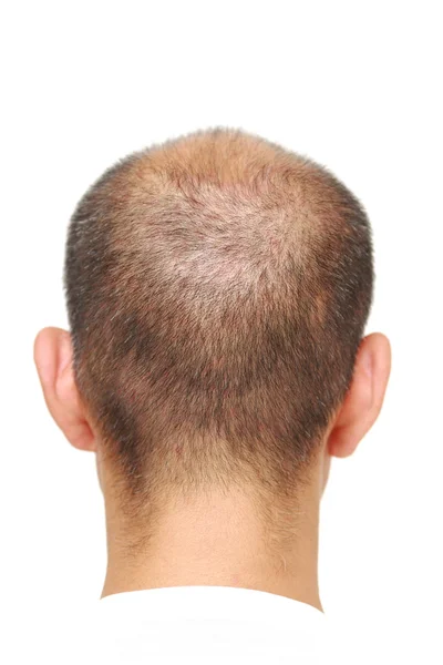 Thin hair — Stock Photo, Image