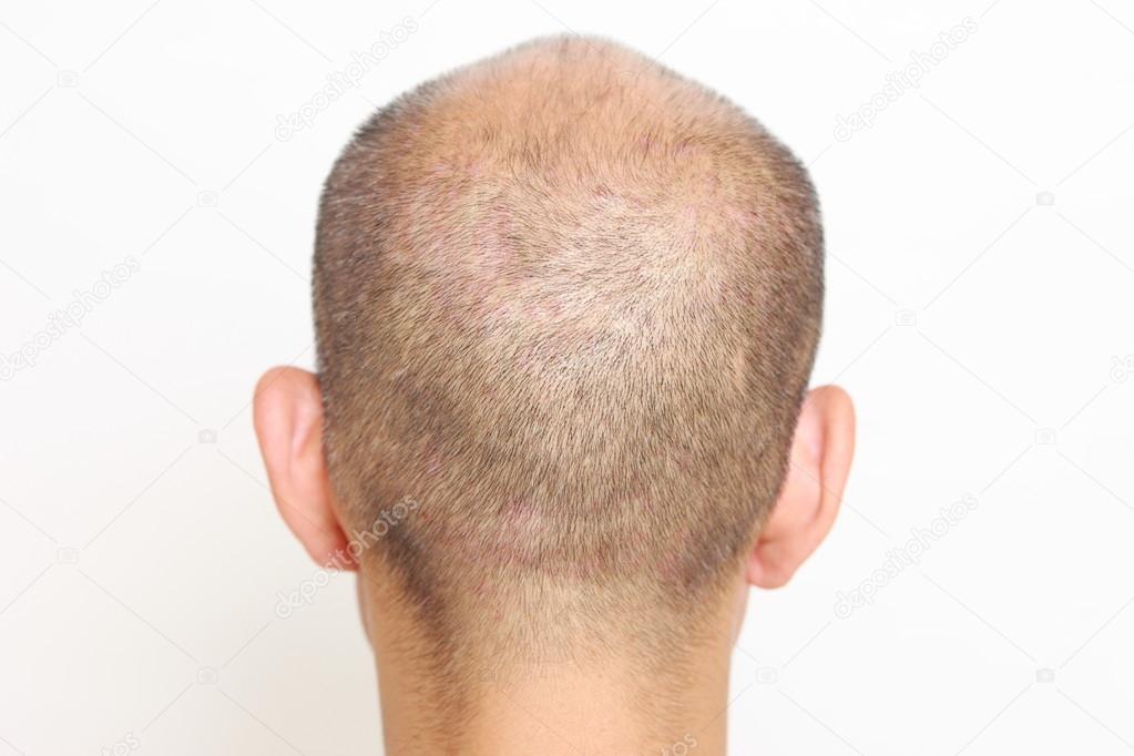 Thin hair