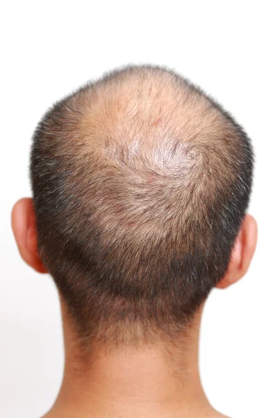 Thin hair — Stock Photo, Image