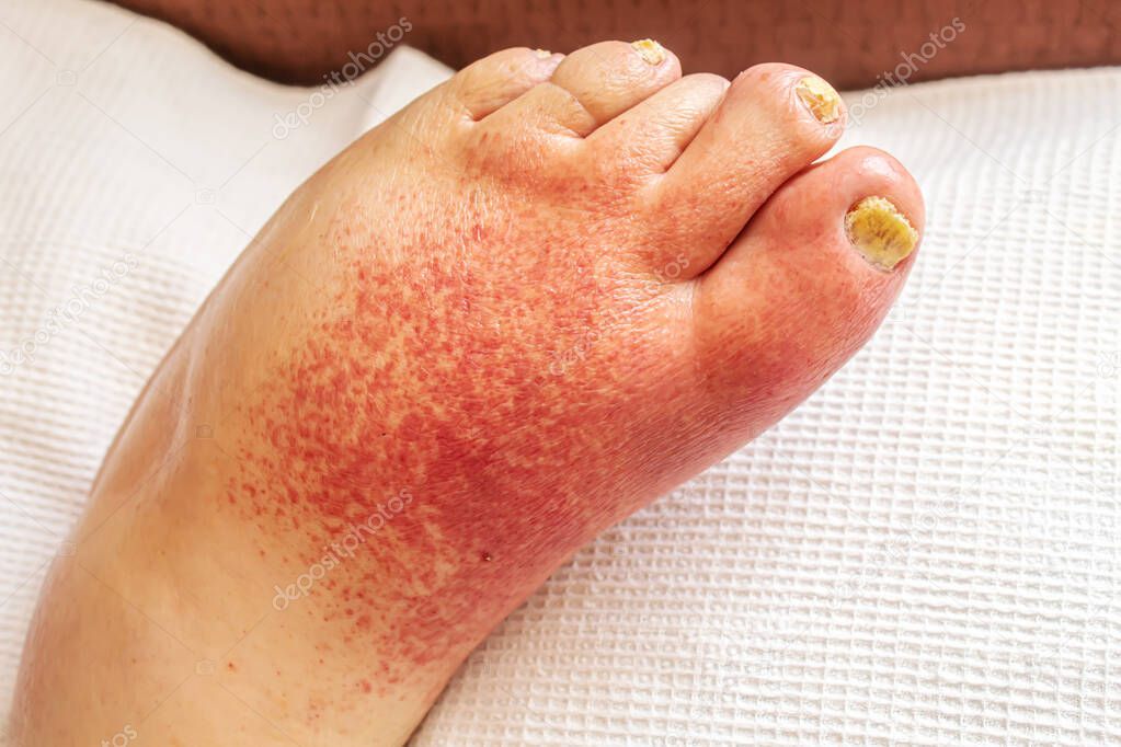 erysipelas of the legs, red rash on the legs.selectivw focus