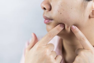 Gri arka planda sivilce sorunu olan genç bir kadın.