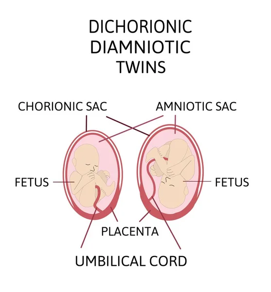 Anatomie Van Buik Met Tweeling Twin Types Infographic Elementen Plat — Stockvector