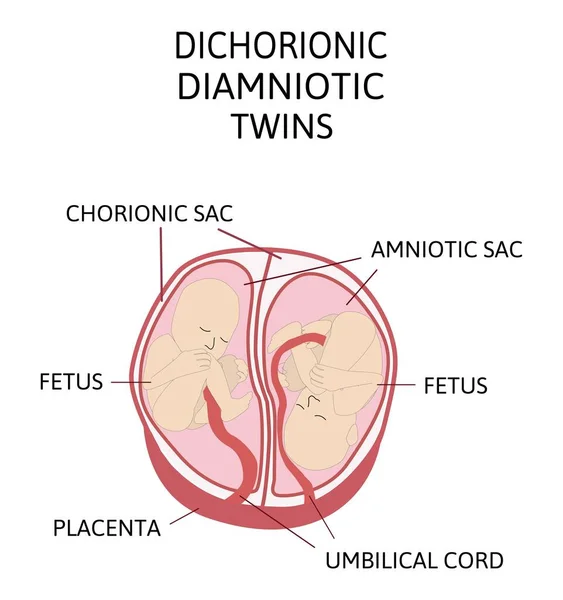 Anatomy Abdomen Twins Twin Types Infographic Elements Flat Design Monozygotic — Stock Vector