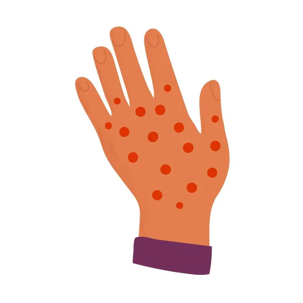アレルギーと手を組め 皮膚は赤い発疹で破壊をカバー アトピー 表皮重度のアレルギー性皮膚炎の湿疹 ベクトル — ストックベクタ