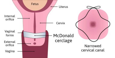 Transabdominal serklaj. Gebelik sırasında rahim ağzı açılacak. Rahim boynu anatomisi, McDonald Serclage. Rahminde rahim boynu zayıflığı ve mavi serklaj var. Çizgilerle işaretlenmiş vektör çizimi. Tıbbi çizim izole